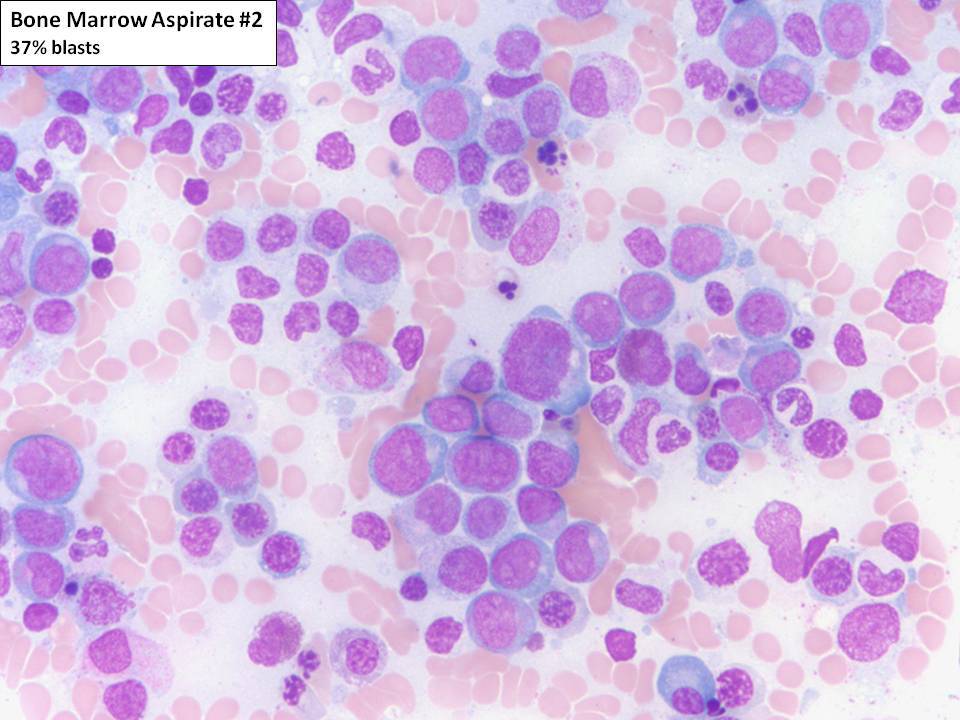 Bone marrow aspirate #2: The bone marrow aspirate shows approximately 37% blasts similar to those seen in the peripheral blood. Dyserythropoiesis is present in the background.